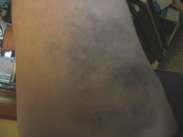 Slackline bruise!